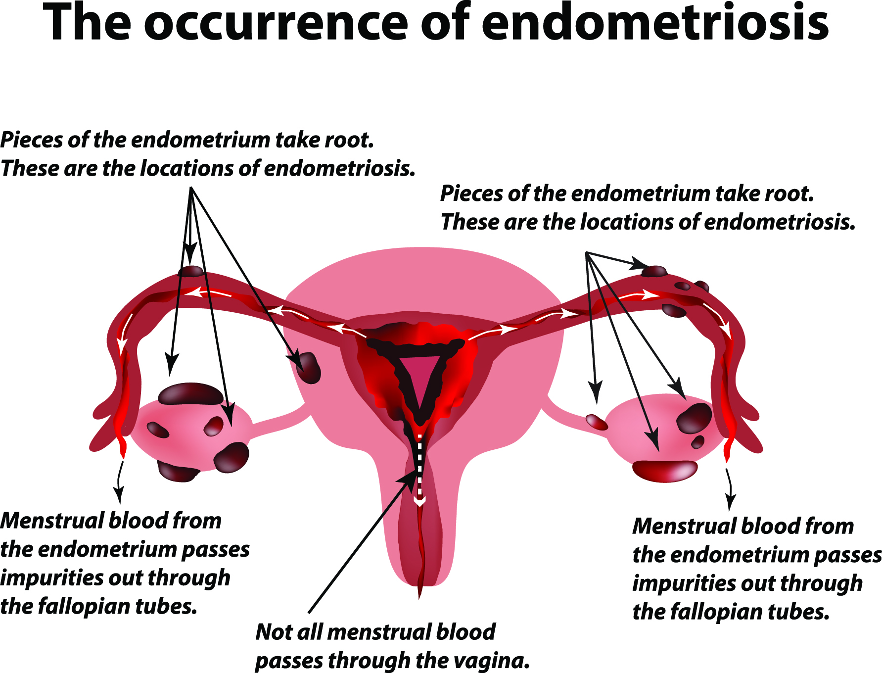 iunderstandendometriosis